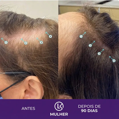 Shampoo Antiqueda e Tônico | DHT™